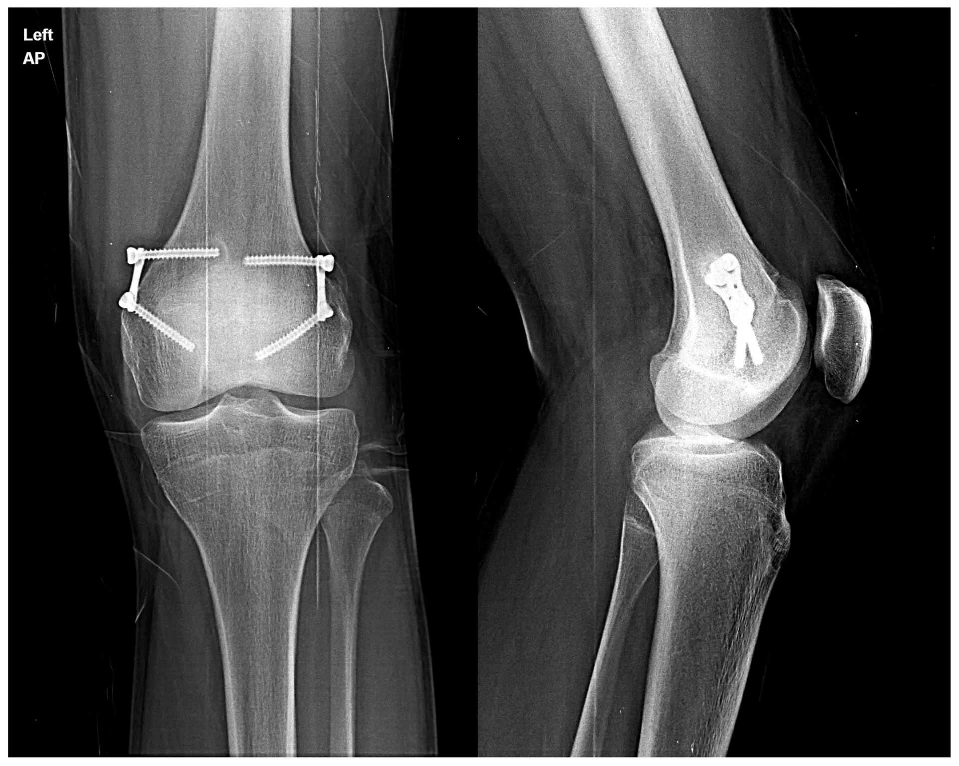 Leg Deformities X-Ray - 1