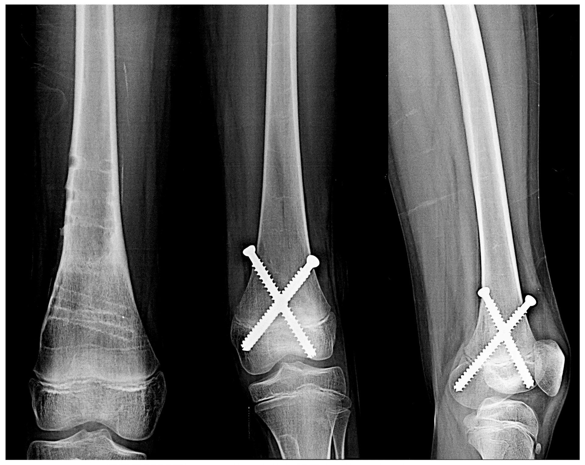 Limb Lengthening Surgery X-Ray - 2
