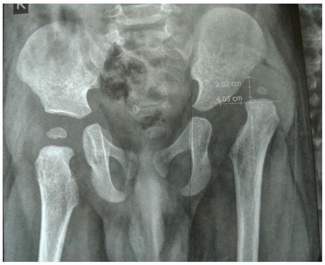 Congenital Hip Dislocation Treatment X-Ray - 1