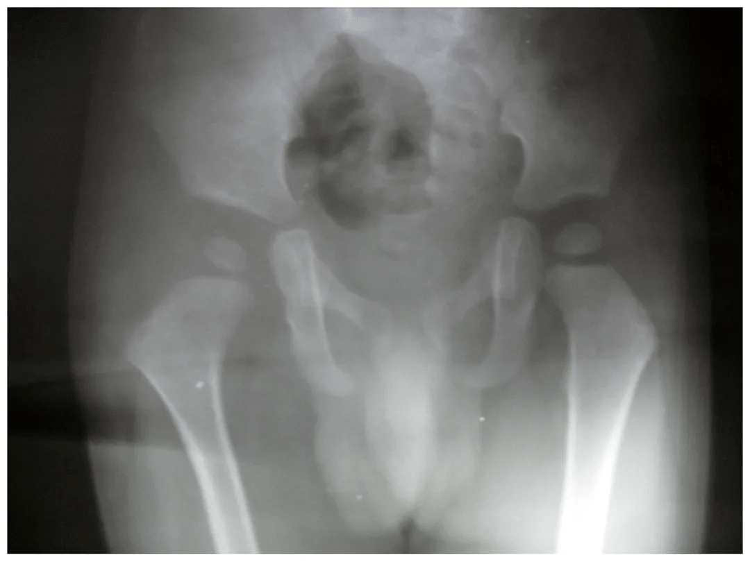 Congenital Hip Dislocation Treatment X-Ray - 2