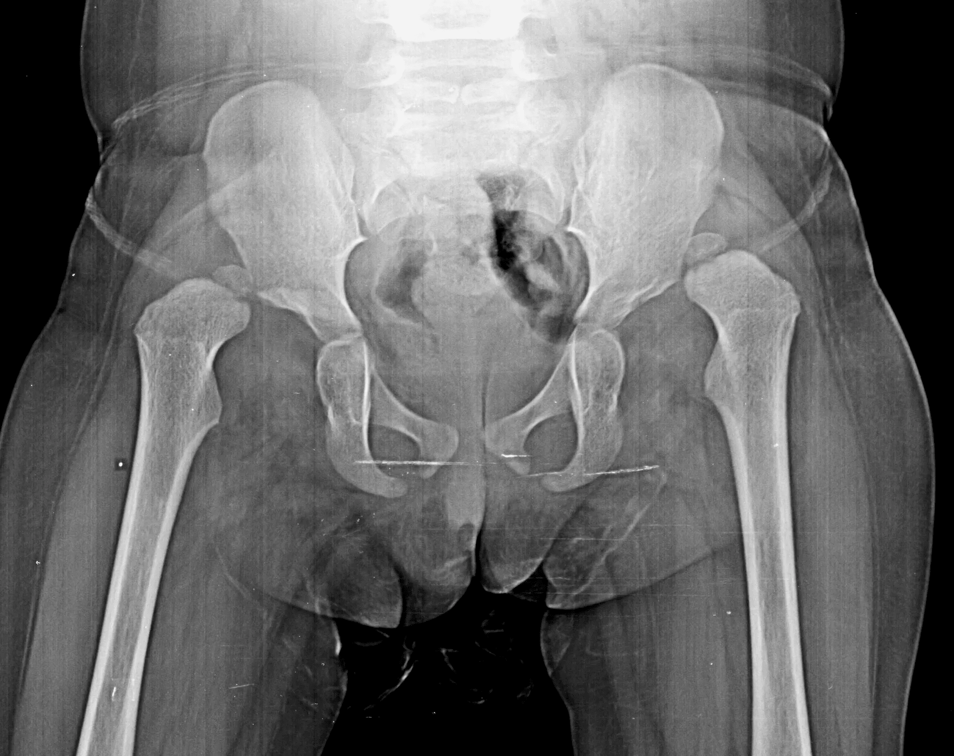 Congenital Hip Dislocation Treatment X-Ray - 3