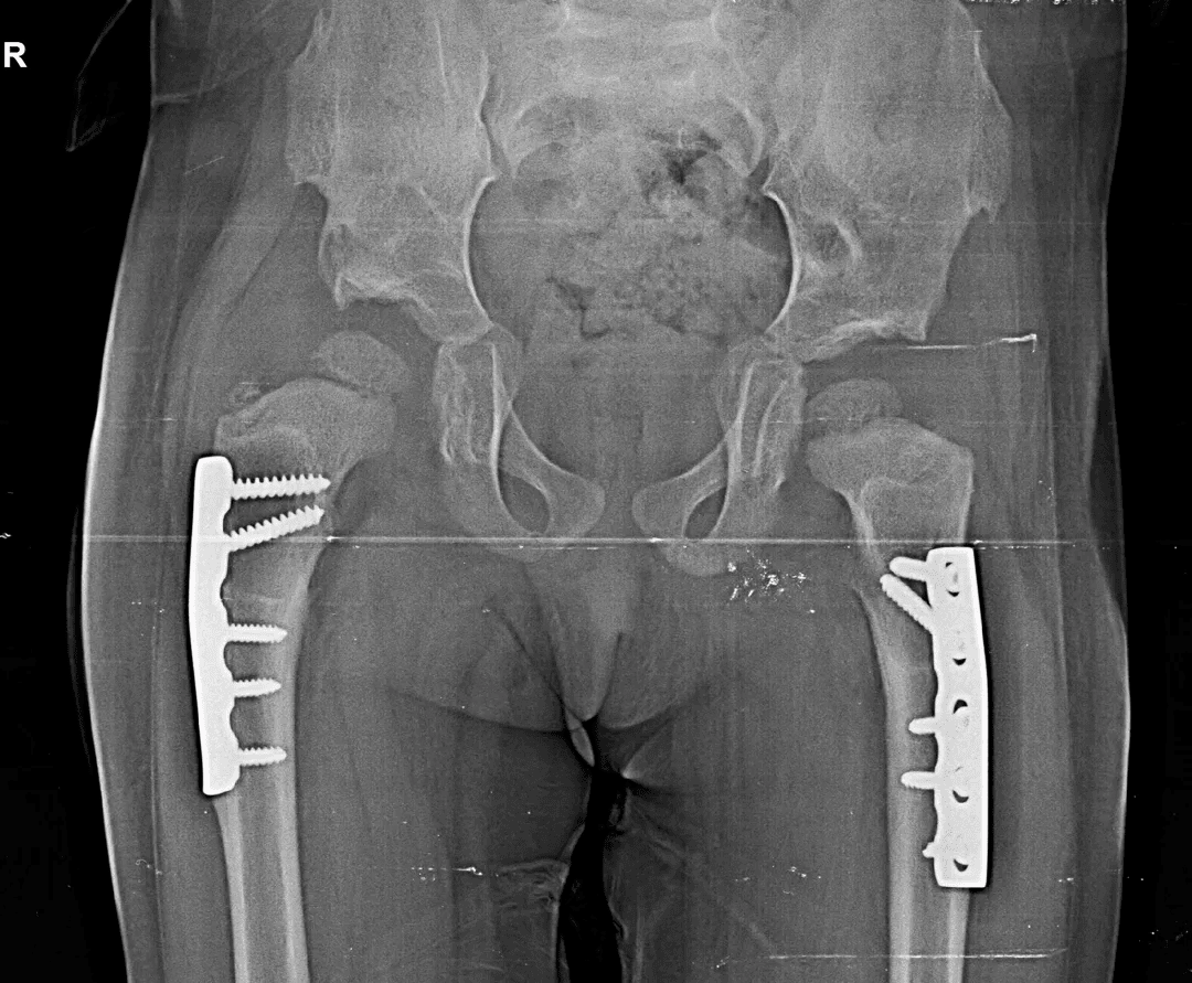 Congenital Hip Dislocation Treatment X-Ray - 4