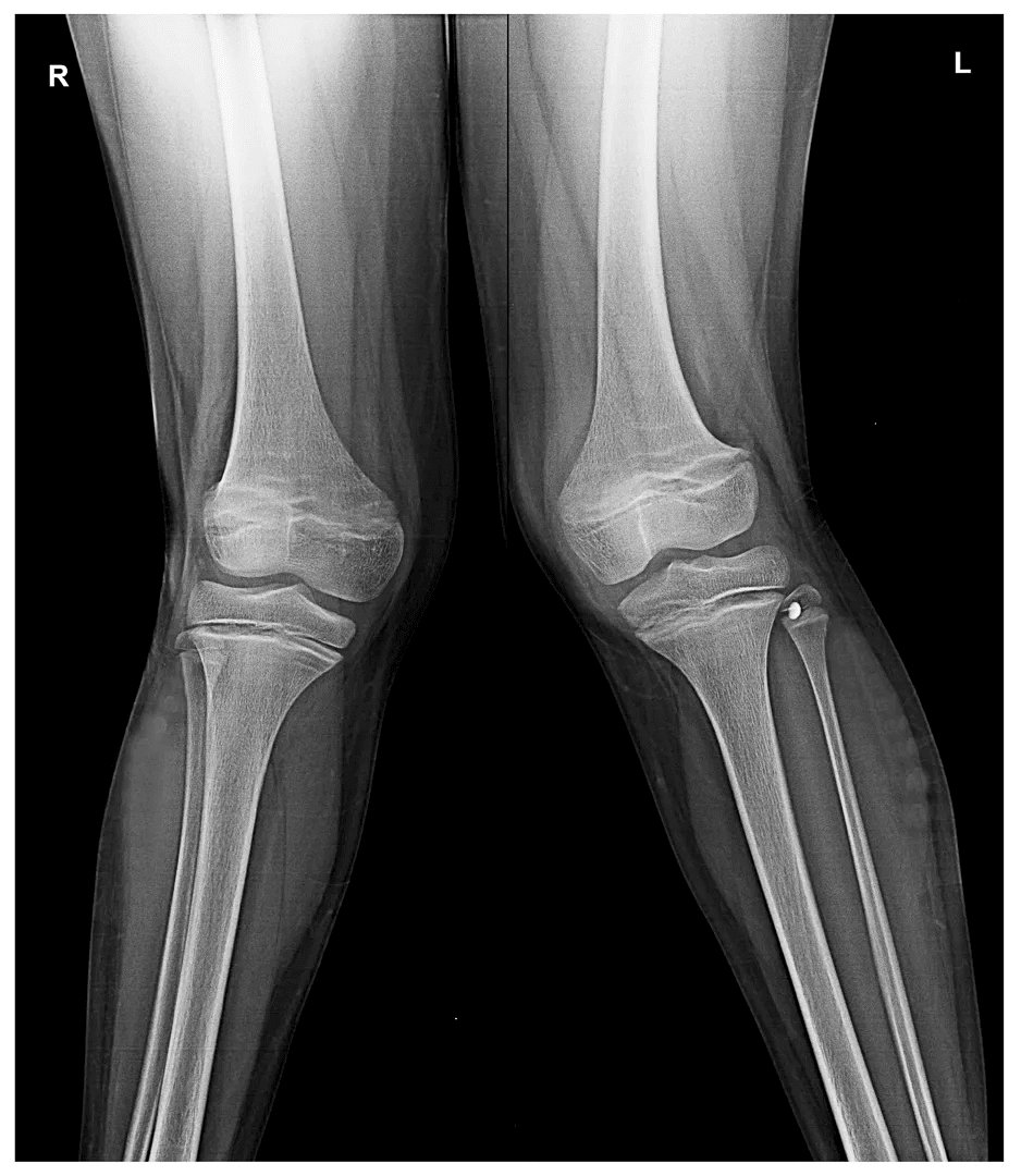 Knock Knees Treatment X-Ray - Before