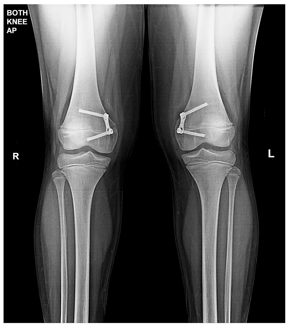 Knock Knees Treatment X-Ray - After