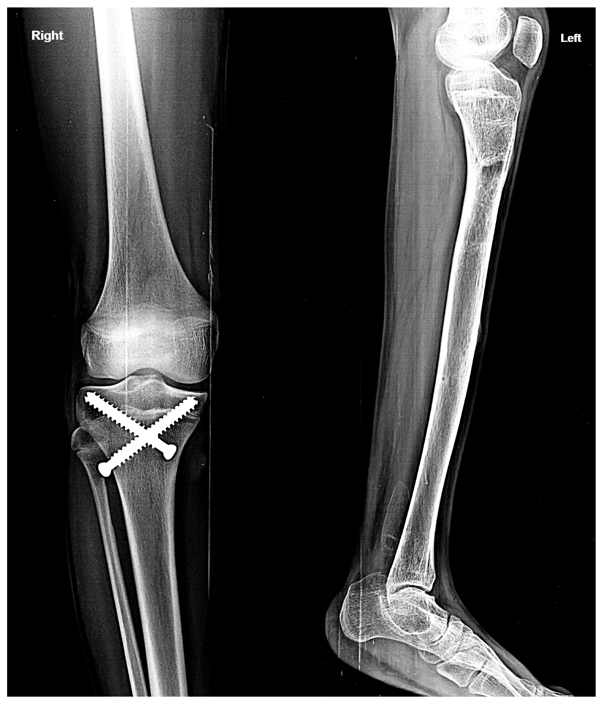 Limb Deformities X-Ray - 2