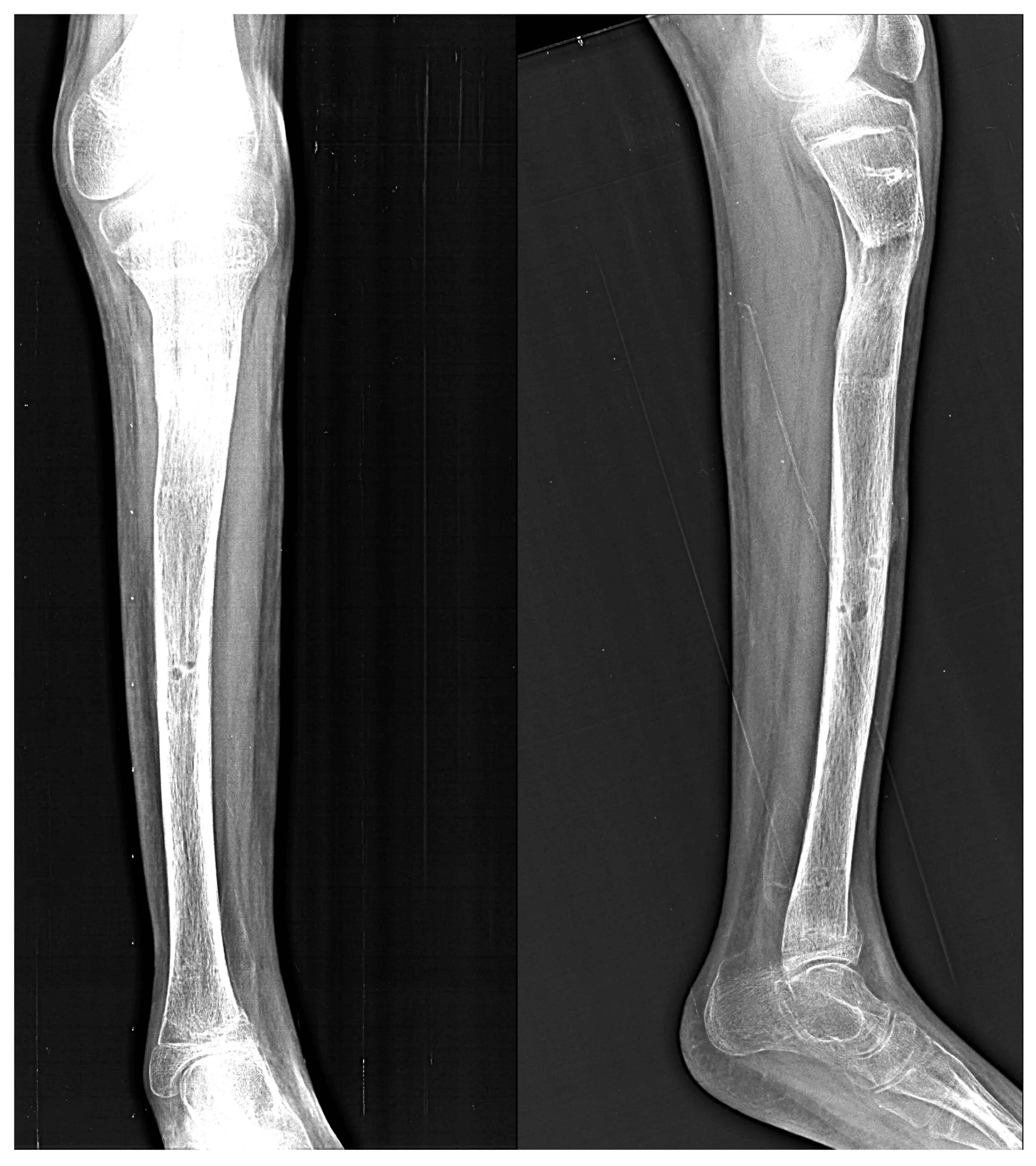 Limb Lengthening Surgery X-Ray - 3