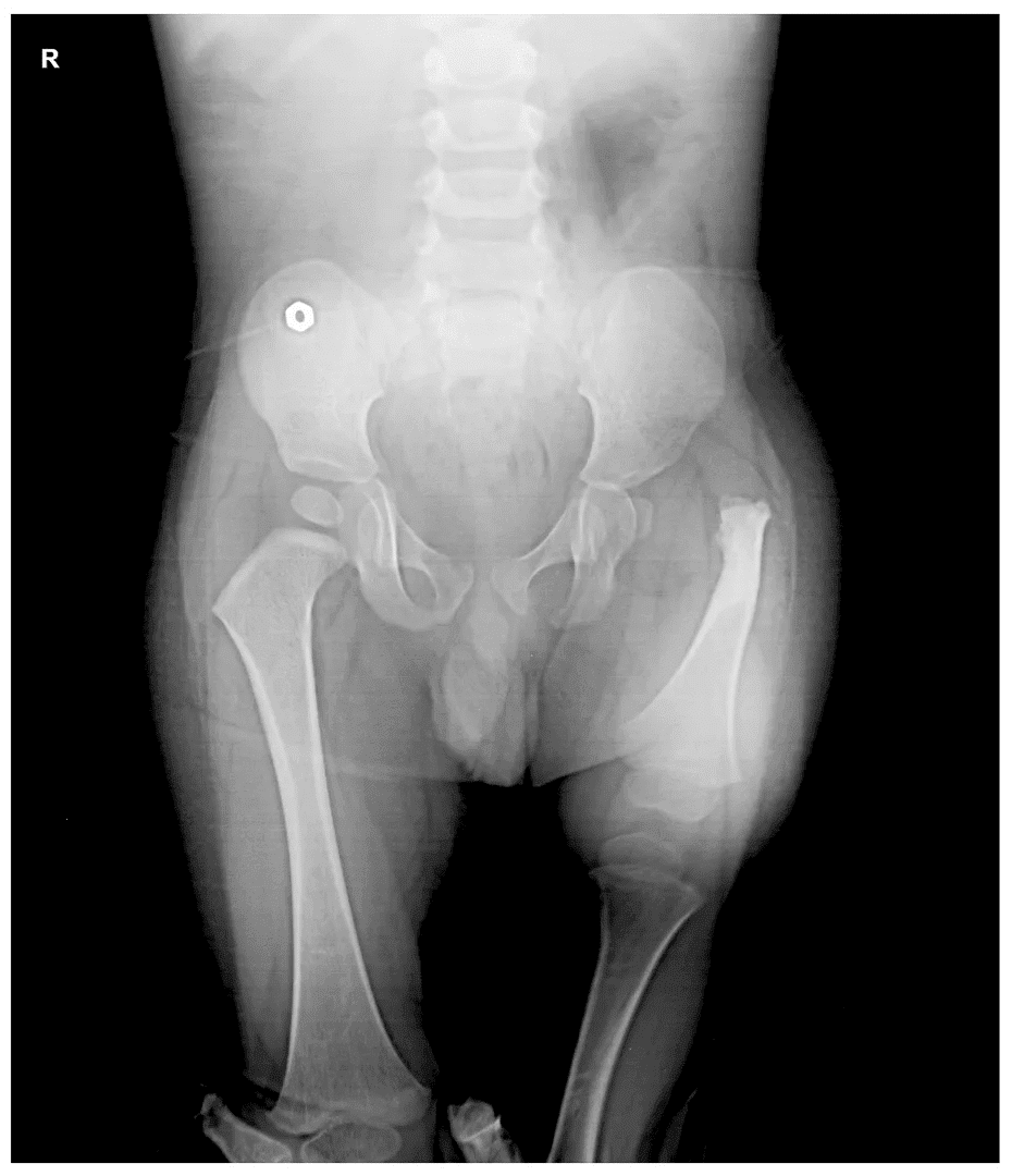 Proximal Femoral Focal Deficiency X-Ray