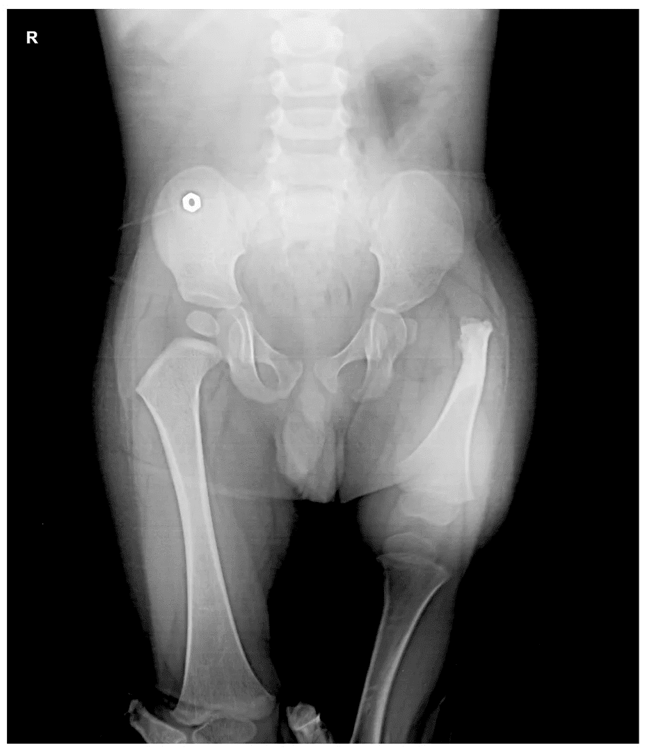 proximal femoral focal deficiency - before surgery - 1 Proximal Femoral Focal Deficiency X-Ray