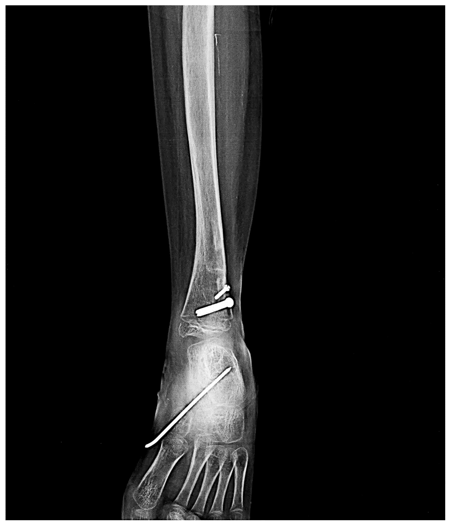 Proximal Femoral Focal Deficiency X-Ray - 2