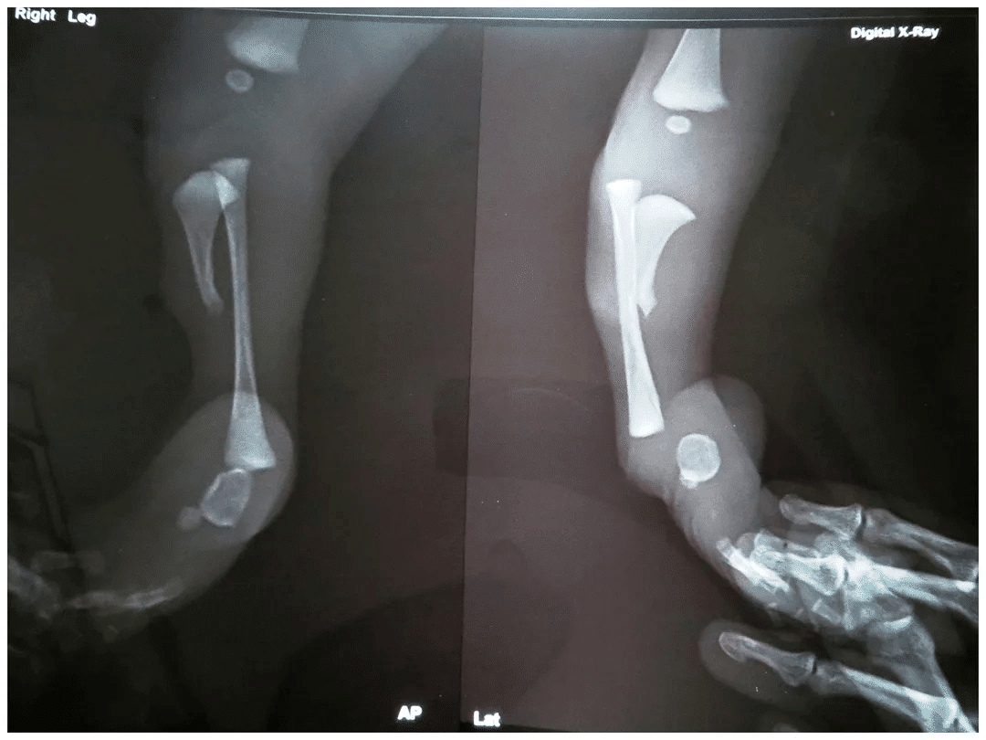 Tibial Hemimelia X-Ray