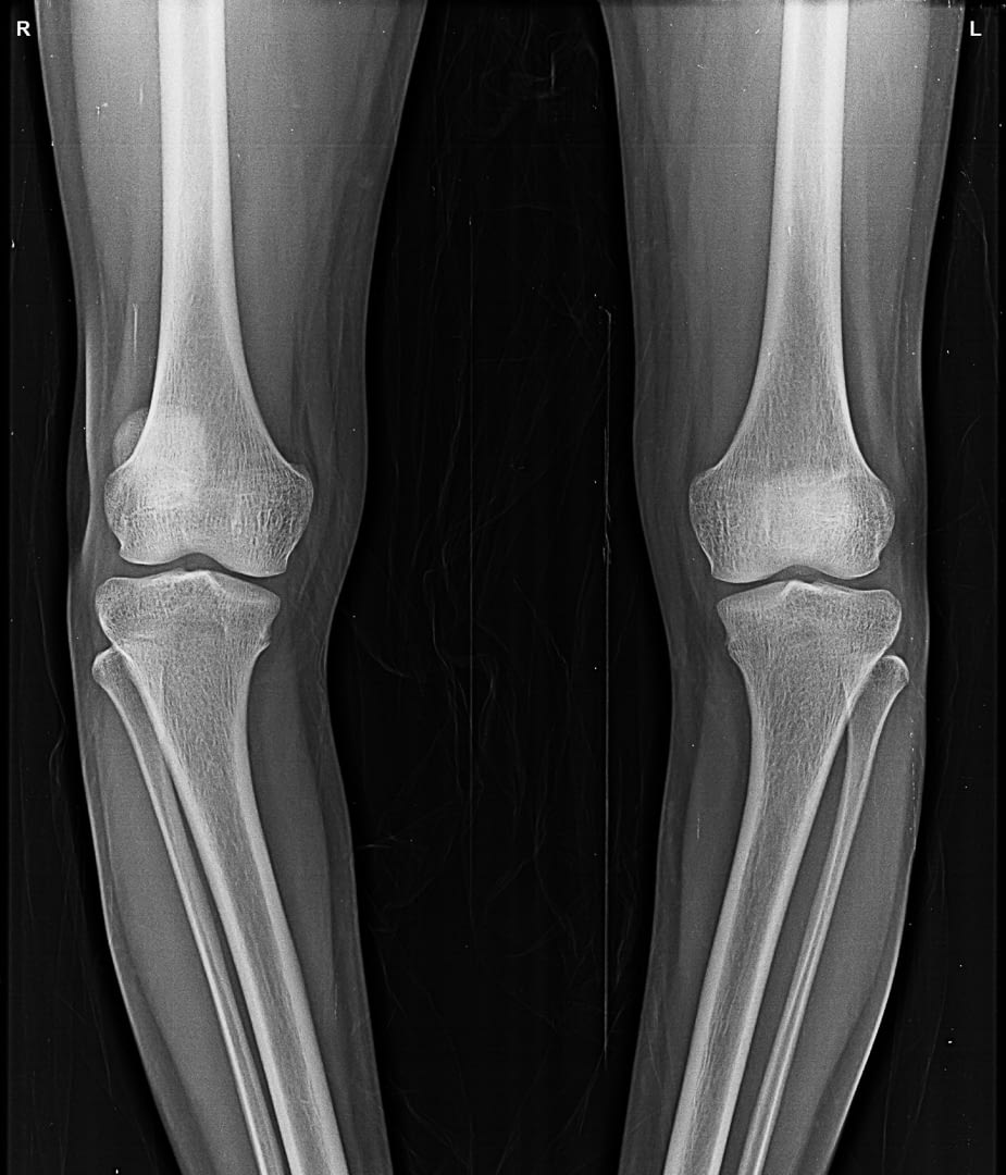Bow Legged Baby Treatment X-Ray