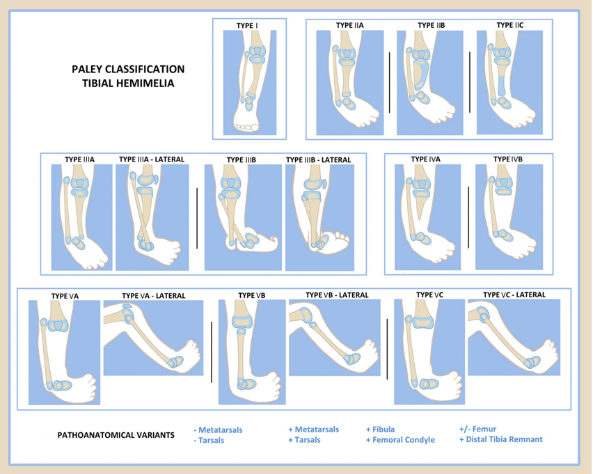 Fibular Hemimelia Classification