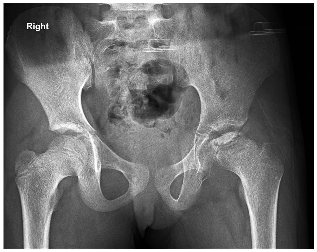 Perthes Disease Treatment before Surgery