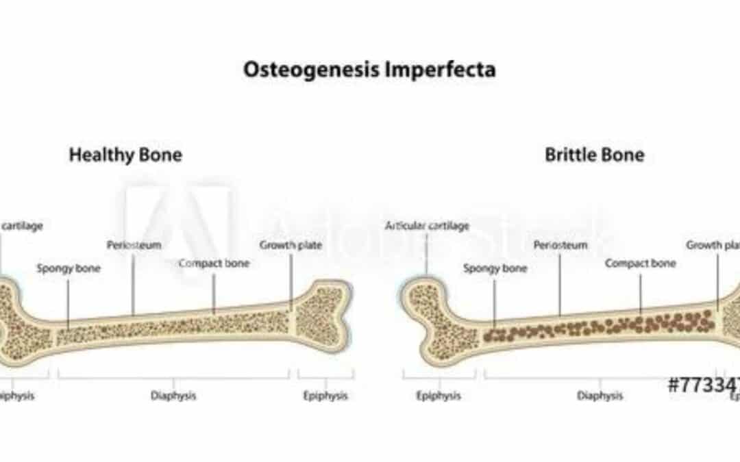 Osteogenesis Imperfecta in Children: Impairment and Disability