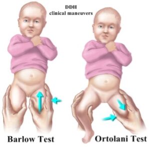 Congenital Hip Dislocation Treatment