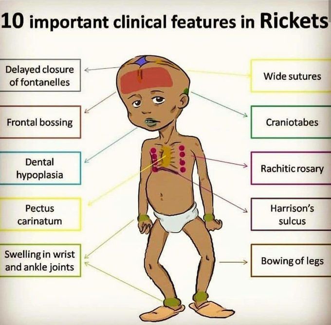 Ricket In Children Sign And Symptoms Cause And Treatment Trishla Ortho