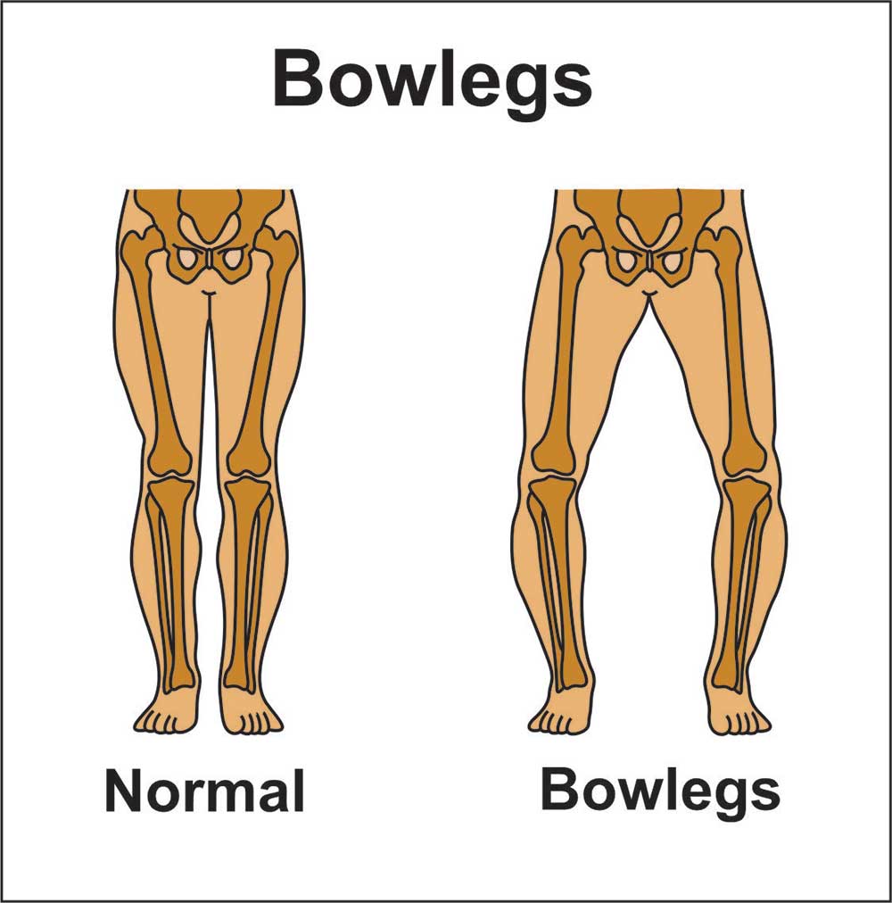 bow leg