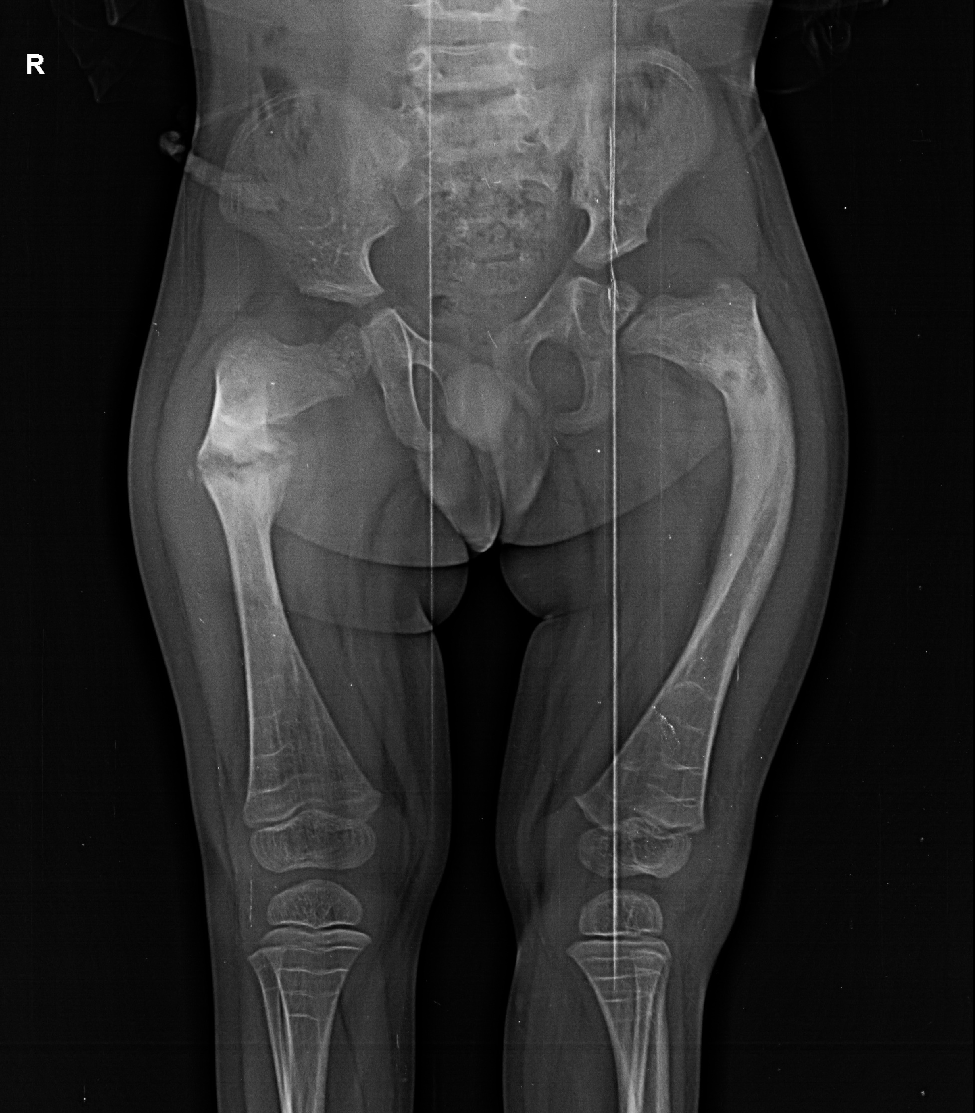 osteogenesis imperfecta