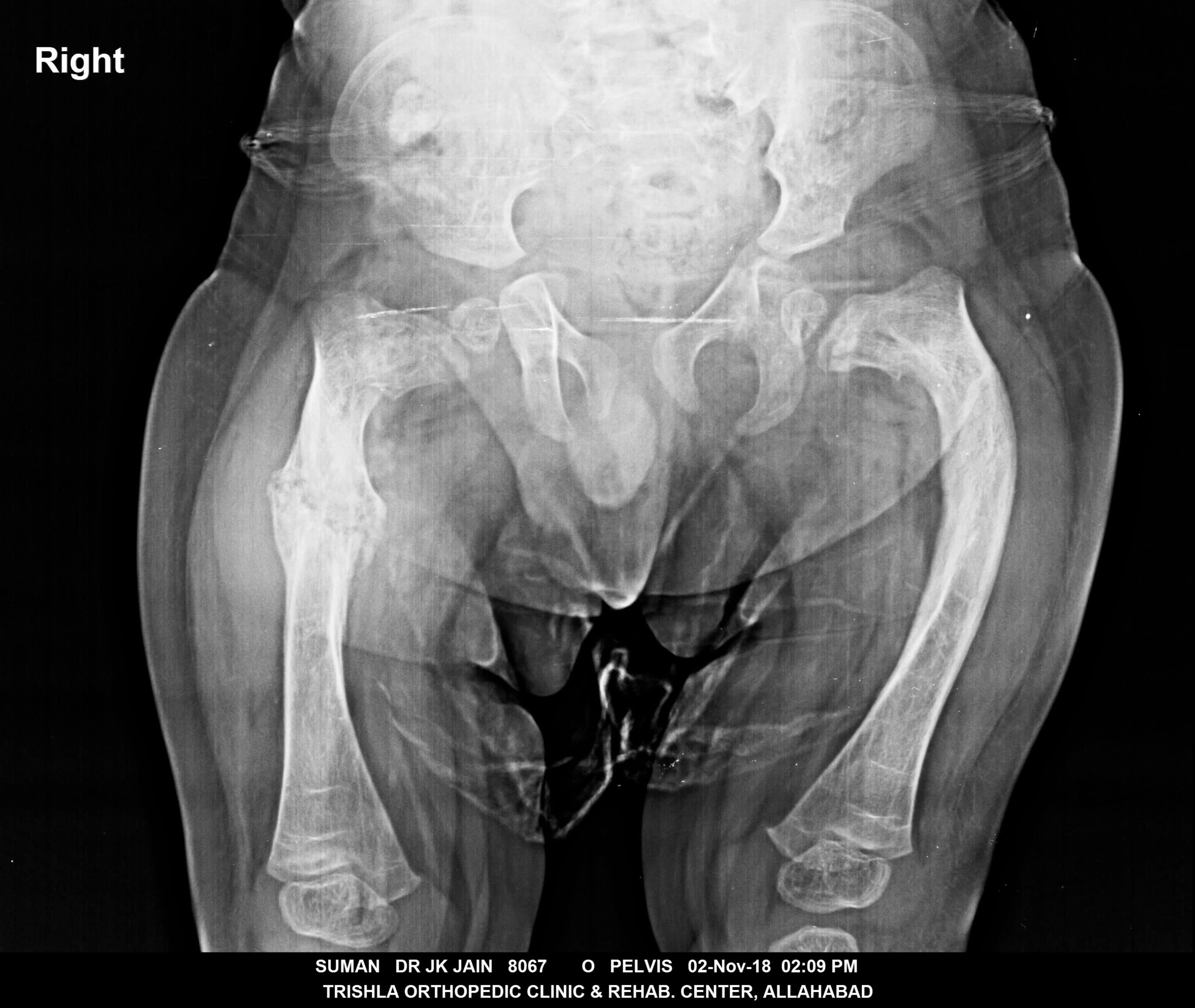 osteogenesis imperfecta