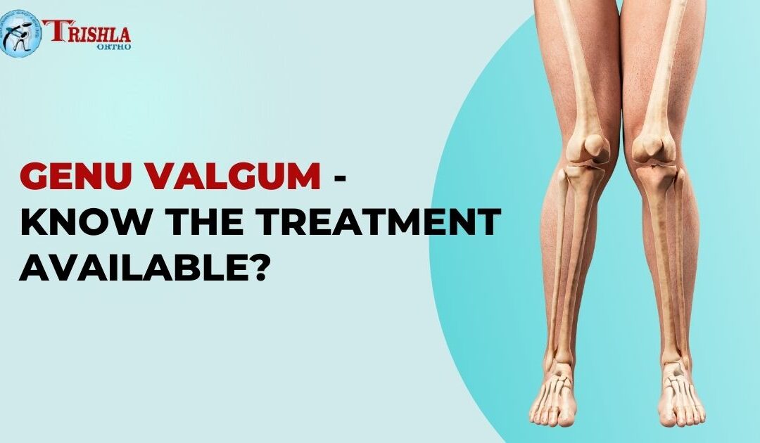 Knock Knees (Genu Valgum) -Treatment