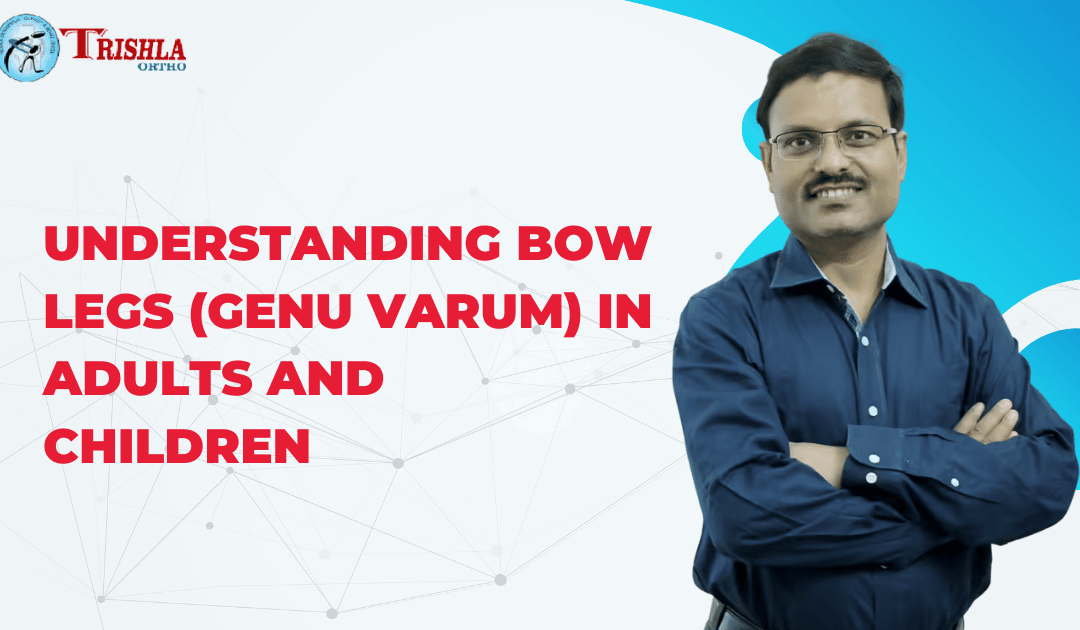 Understanding Bow Legs (Genu Varum)in Adults and Children