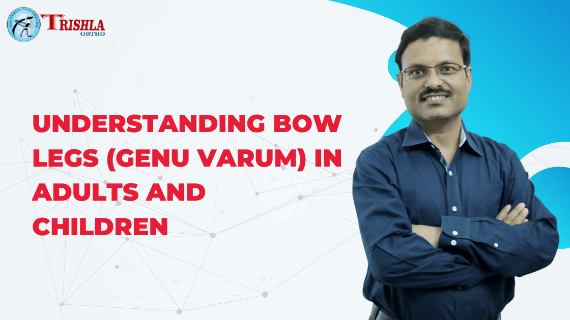 Understanding Bow Legs (Genu Varum)in Adults and Children