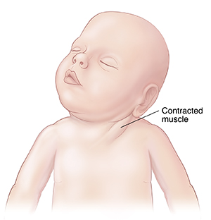 torticollis-treatment-baby