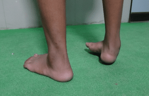 Club foot in elder children