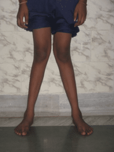 bilateral genu valgus in child