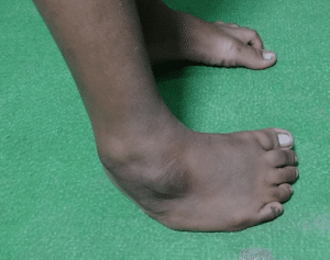 Club foot in elder children