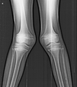 Bilateral genu valgus x-ray of bilateral genu valgus in child