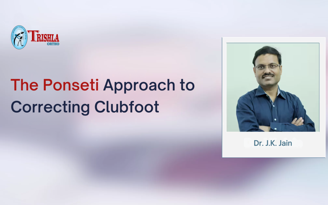 The Ponseti Approach to Correcting Clubfoot